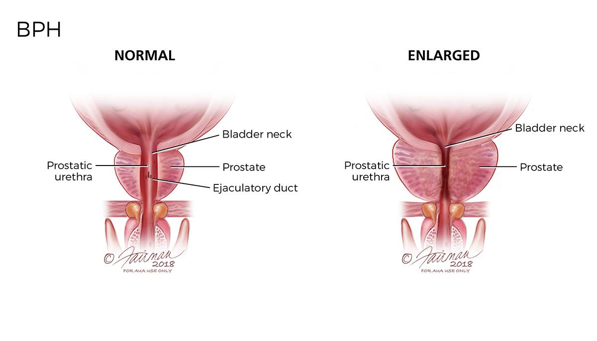 Understanding Benign Prostatic Hyperplasia (BPH): A Comprehensive Overview of Symptoms, Causes, and Risk Factors